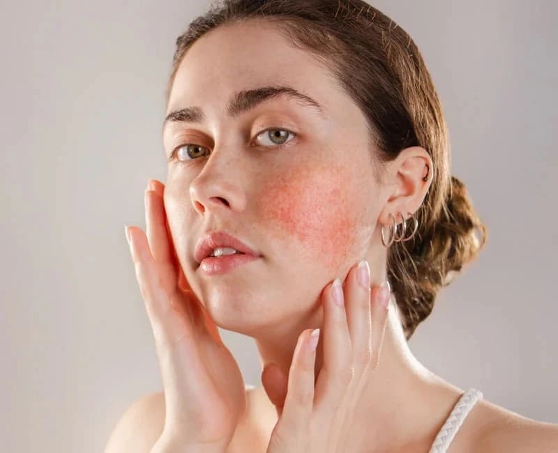 Rosacea condition