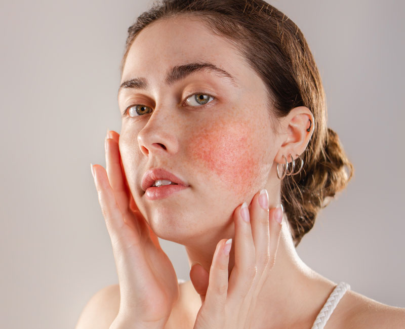 Rosacea condition